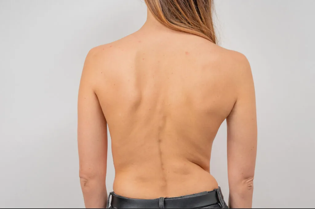 Acupuncture for Scoliosis