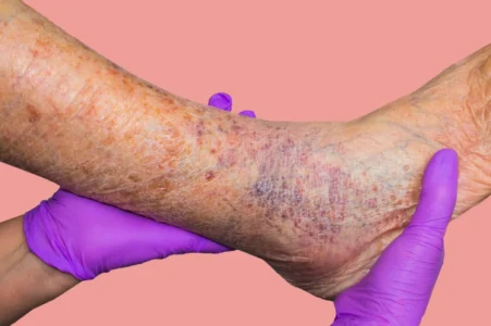 Varicose Veins