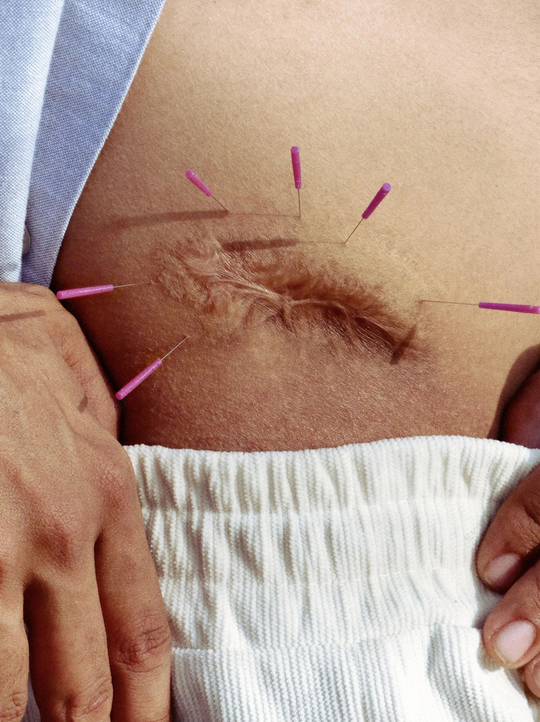 Fertility and IVF support acupuncture at Balancepoint
