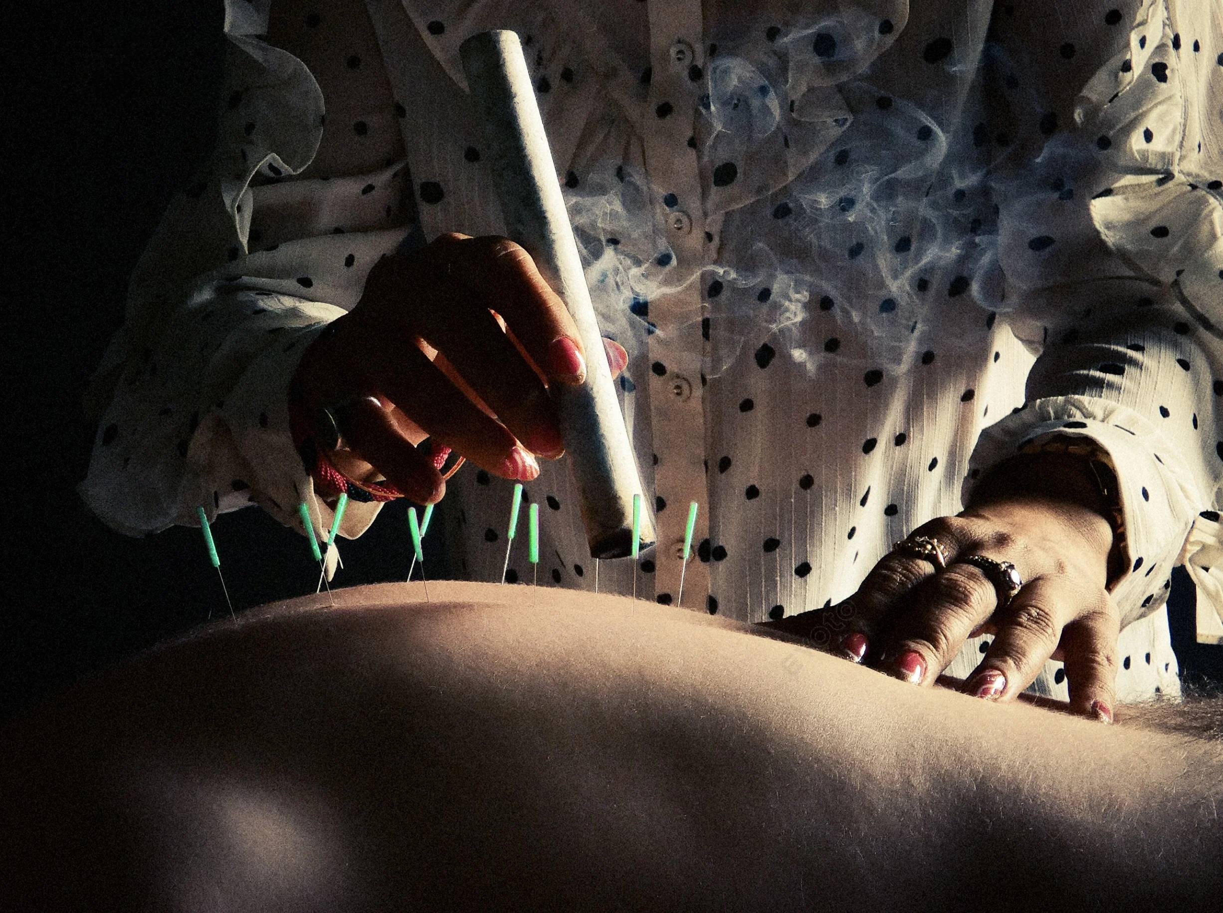 Moxibustion therapy at Balancepoint