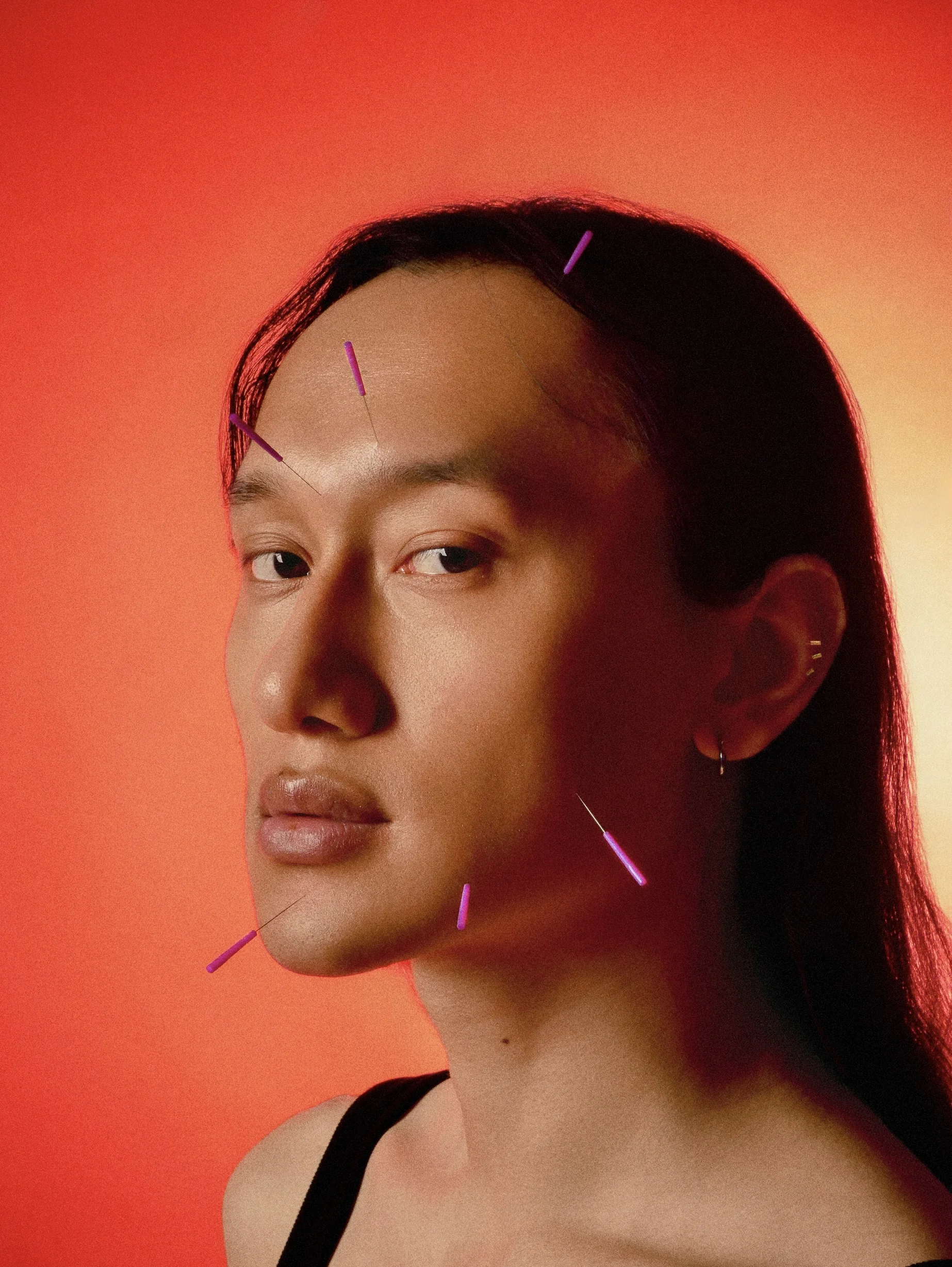 Acupuncture treatment at Balancepoint