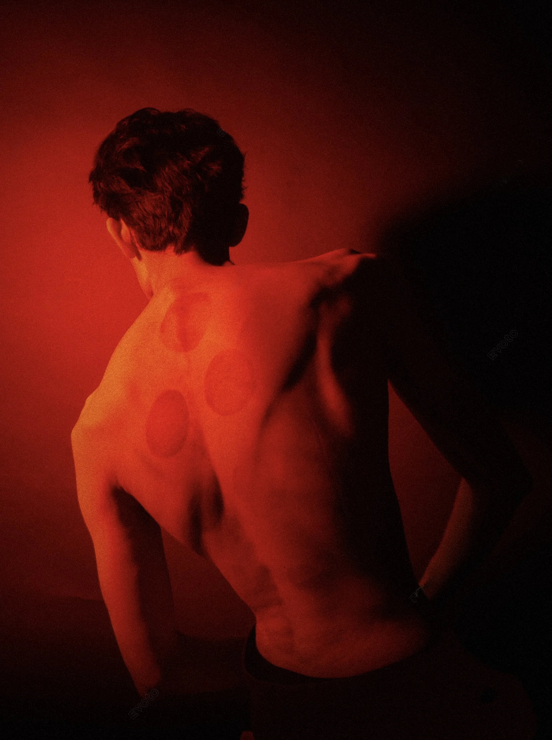 Cupping therapy at Balancepoint