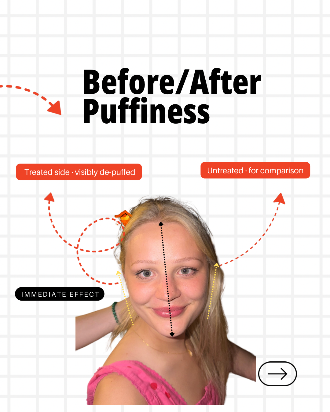 Person demonstrating facial acupressure self-care technique